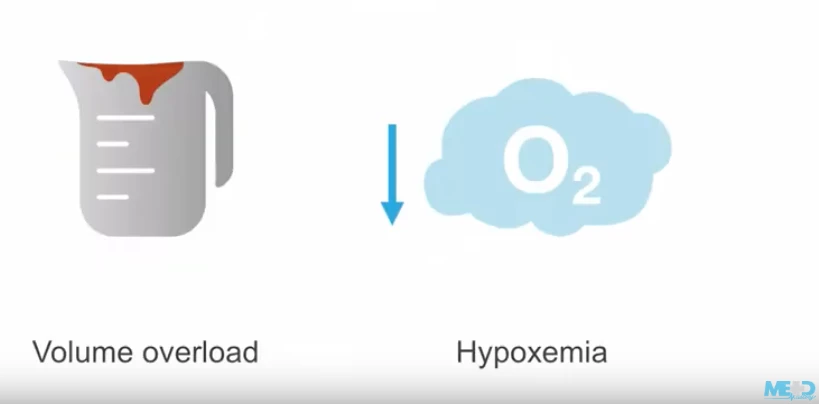 Managing Right Ventricular Dysfunction Medmastery